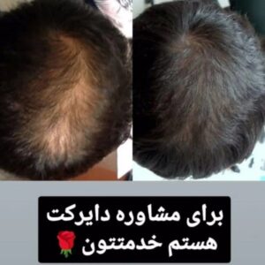 رفع ریزش مو و رویش مجدد مو