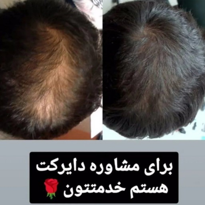 رفع ریزش مو و رویش مجدد مو