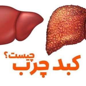 درمان کبدچرب صدرصد تضمینی